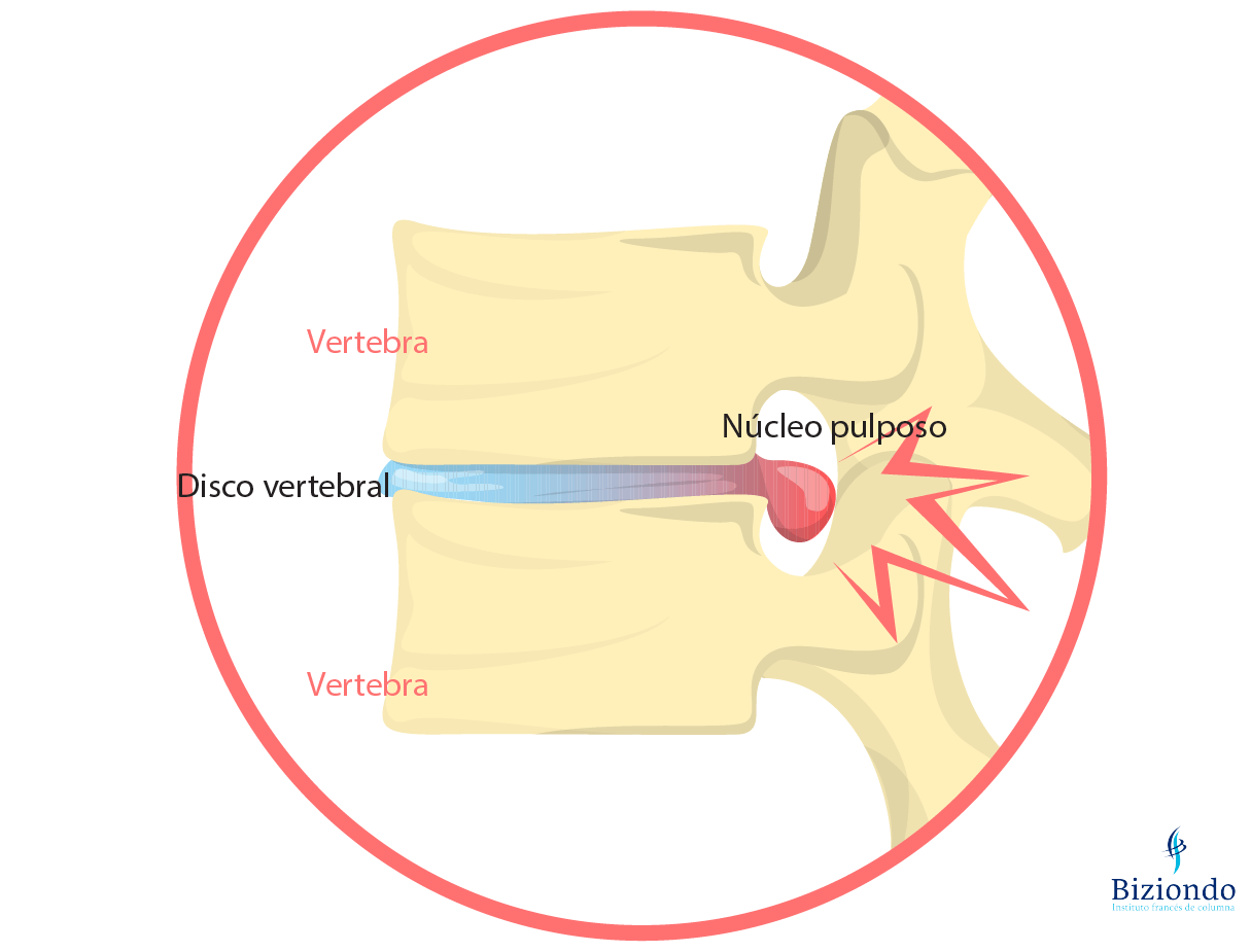 Hernia discal lumbar Síntomas causas y tratamientos seguros